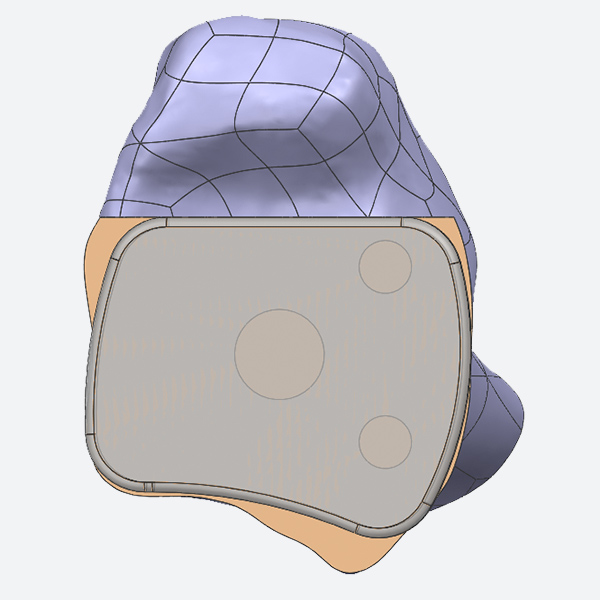 Diseño Tibial de Rodamiento Móvil del Sistema Vantage para Tobillo Total