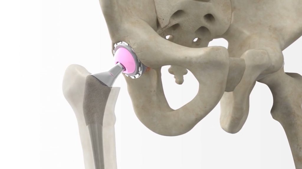 Anterior Approach Hip Patient Animation | es.advita.com