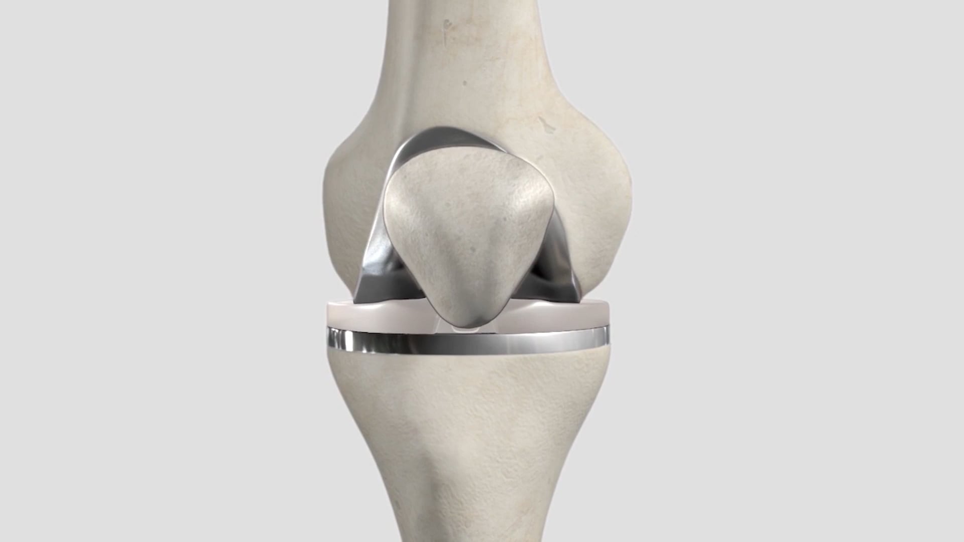 Understanding Total Knee Replacement Surgery Patient Animation